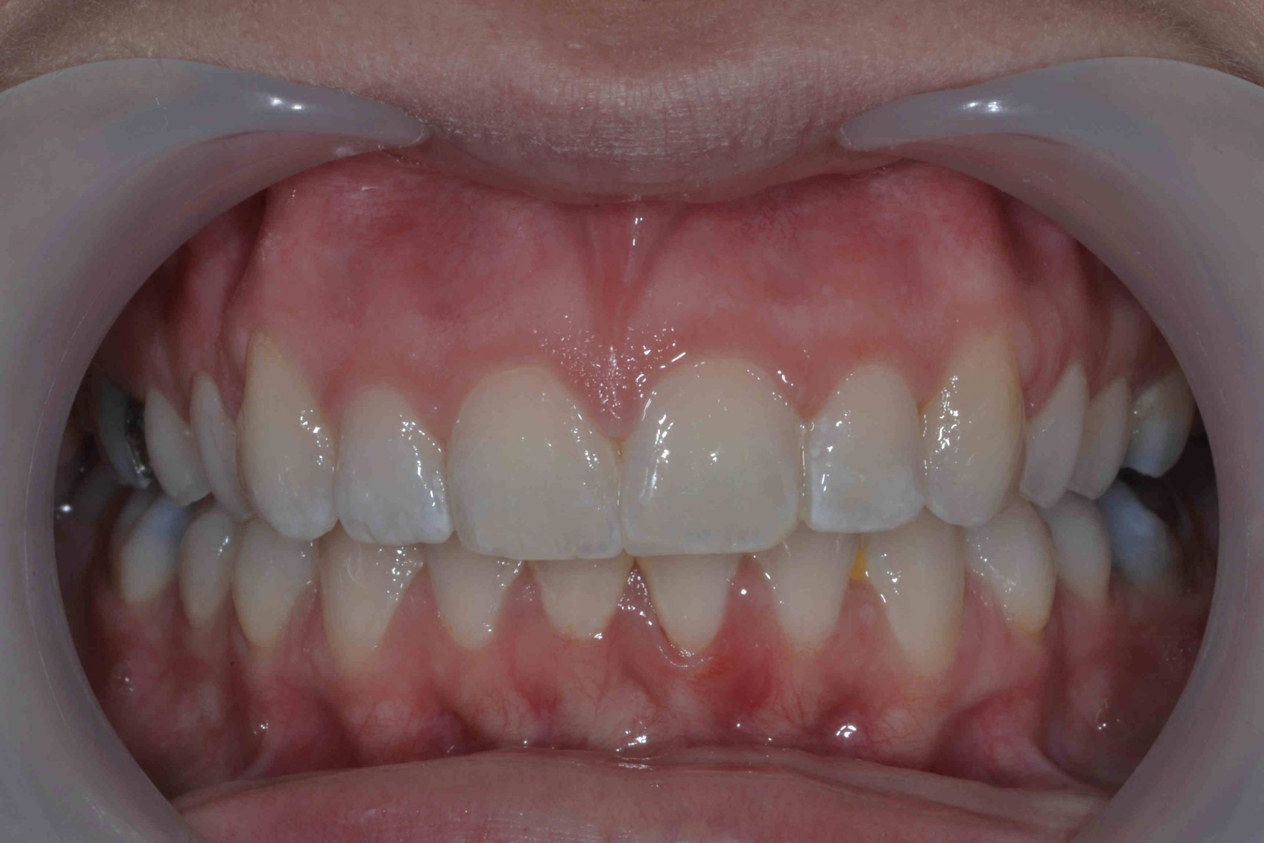 Orthodontic After